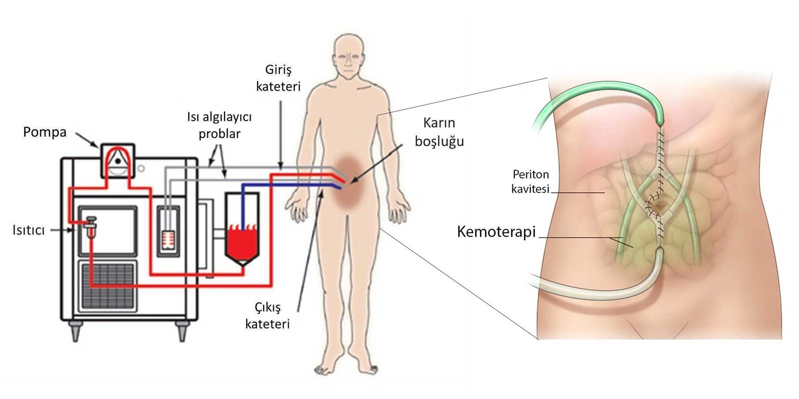 Karın İçi Sıcak Kemoterapinin (HİPEK) Yararı